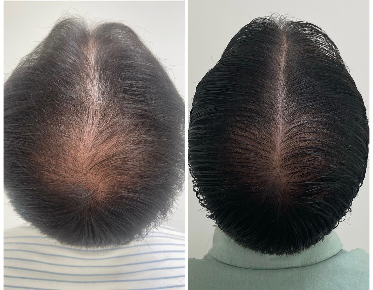 Antes e depois de tratamento capilar com a Dra. Aline Tanus