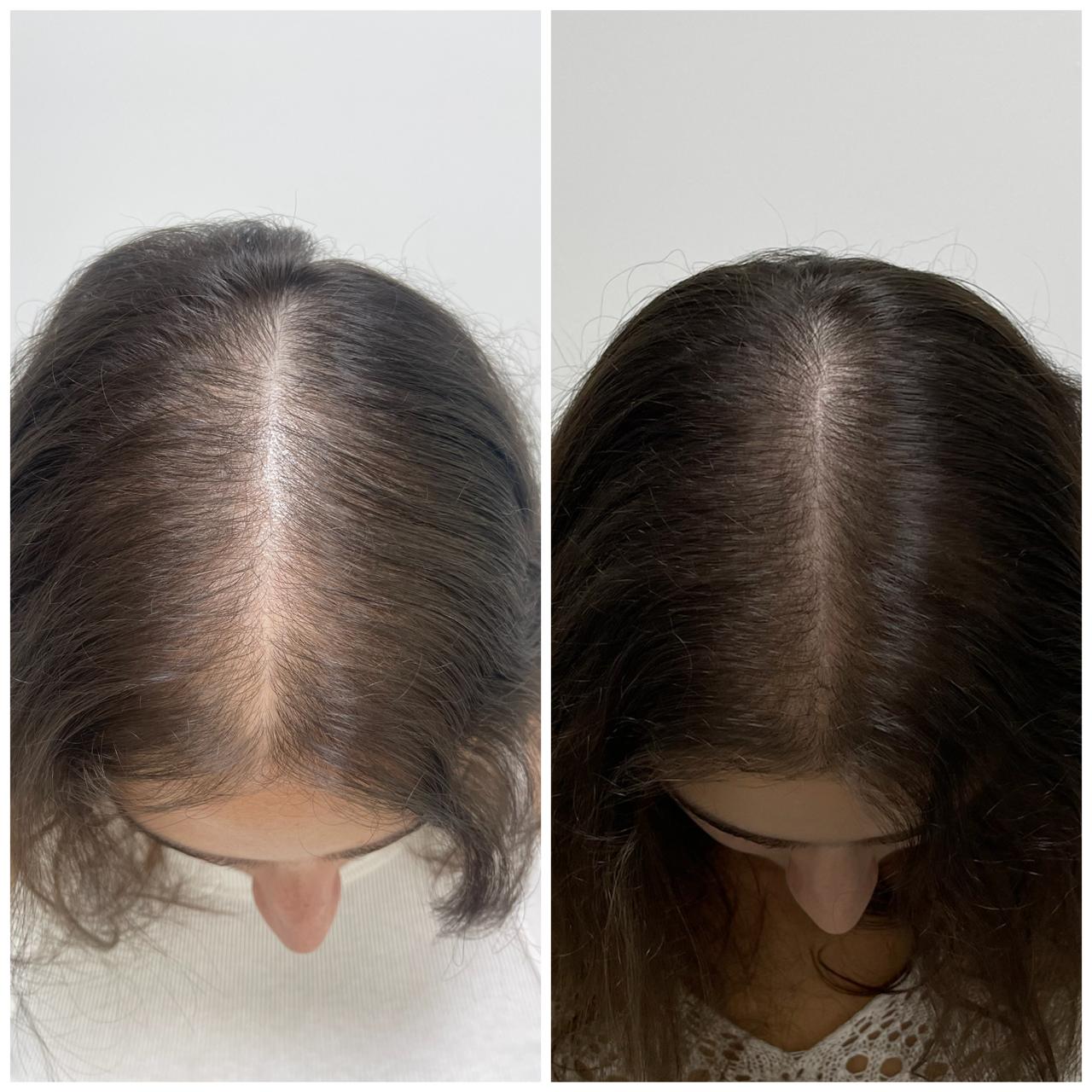 Antes e depois de tratamento capilar com a Dra. Aline Tanus