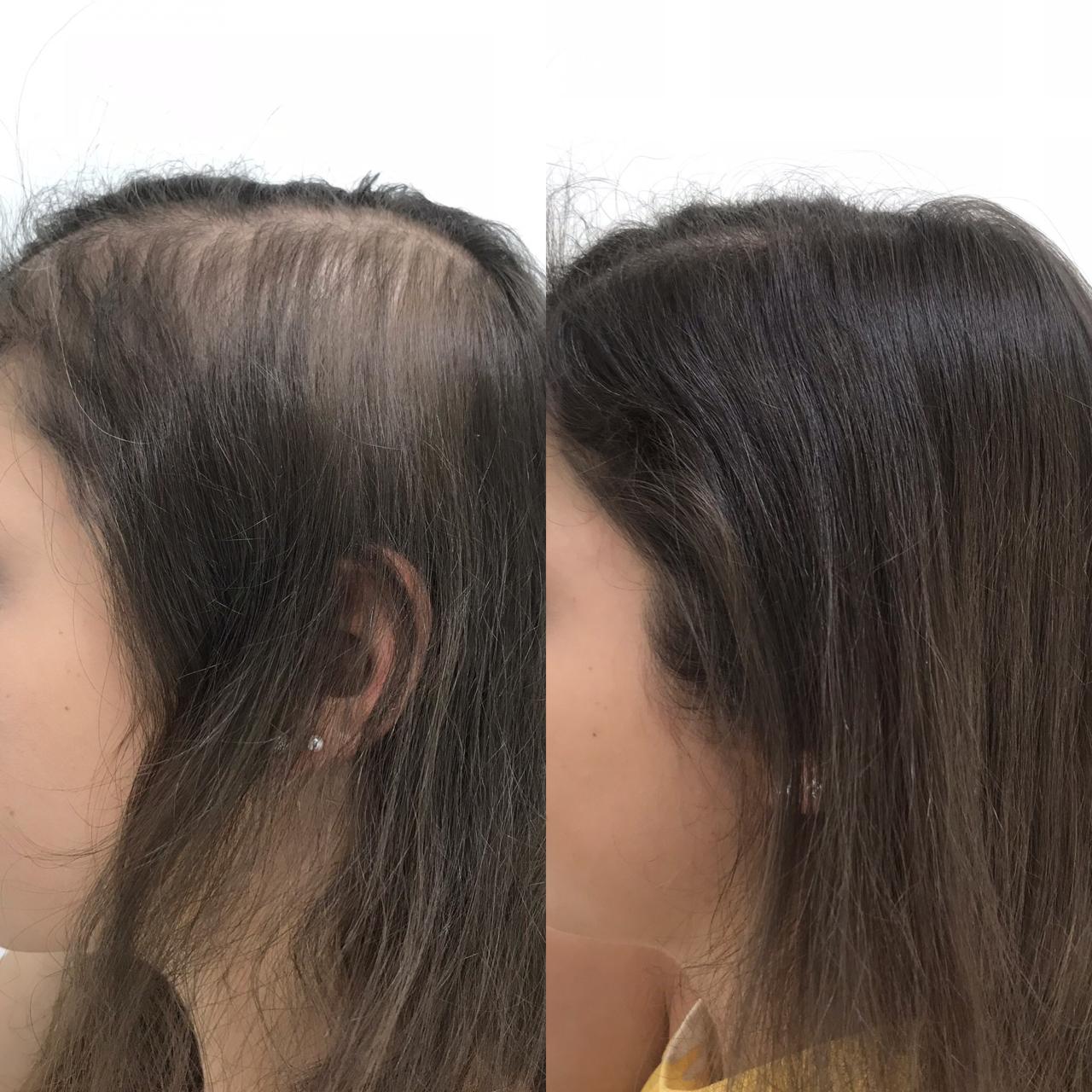 Antes e depois de tratamento capilar com a Dra. Aline Tanus