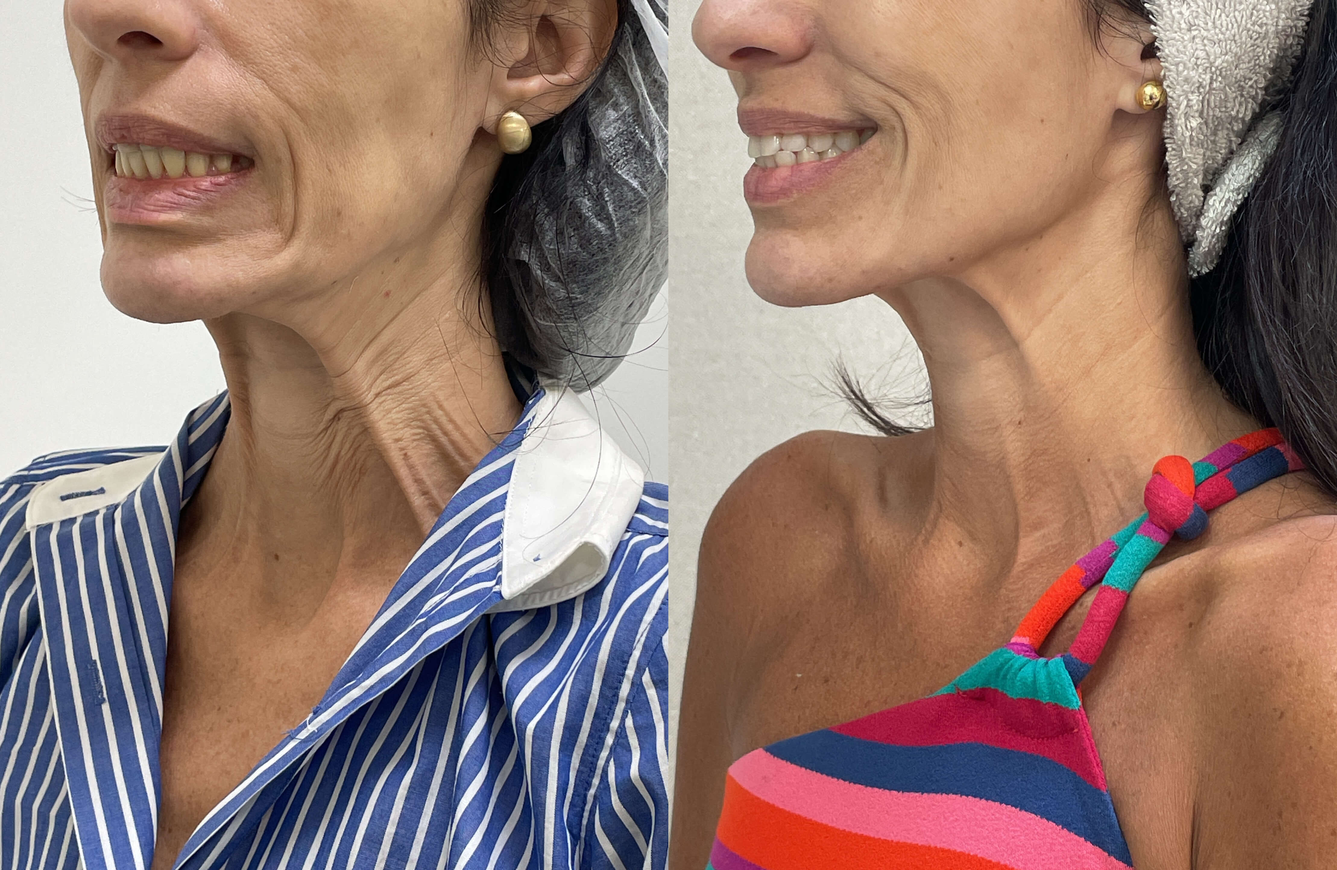 Antes e depois de tratamento estético facial com a Dra. Aline Tanus