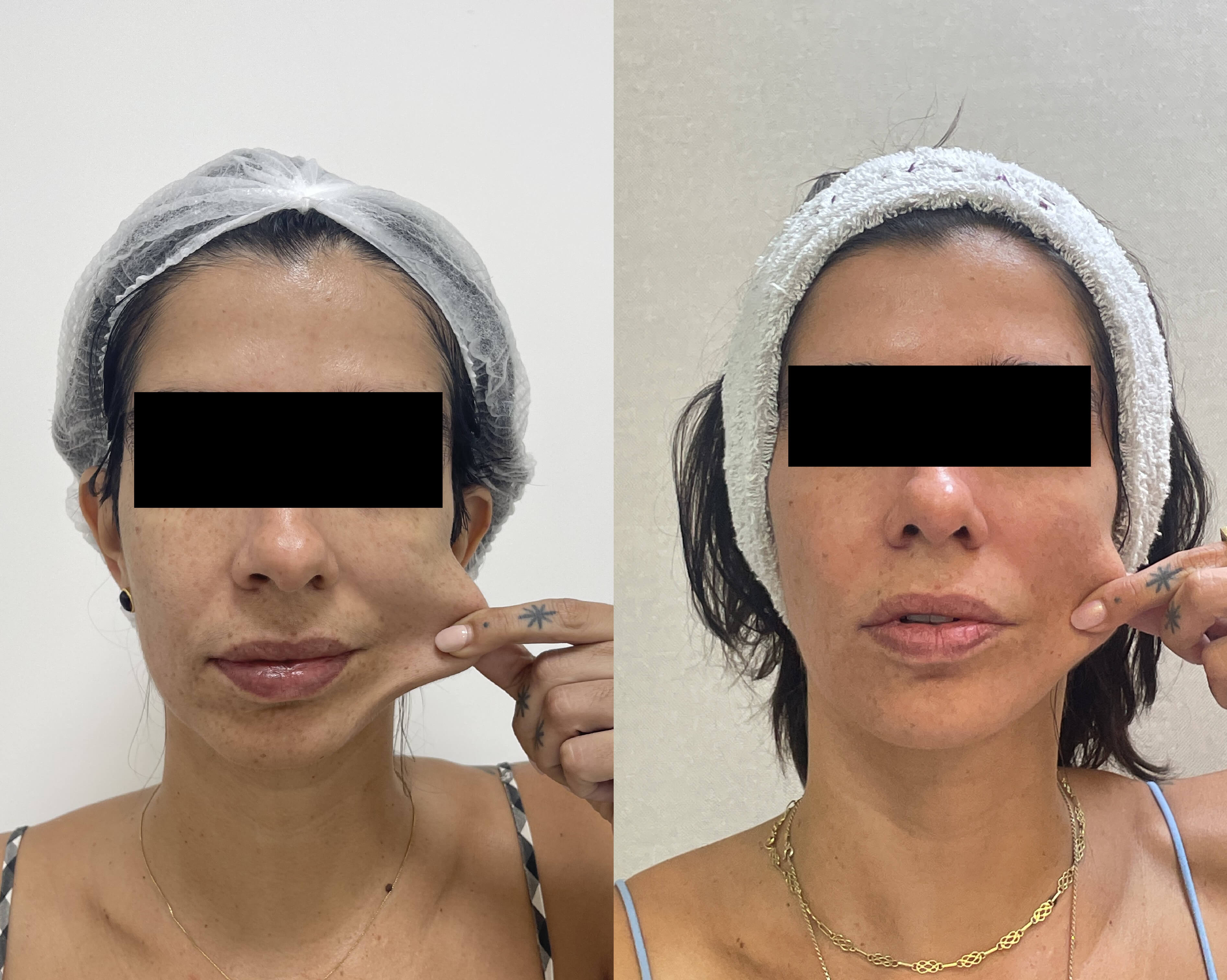 Antes e depois de tratamento estético facial com a Dra. Aline Tanus
