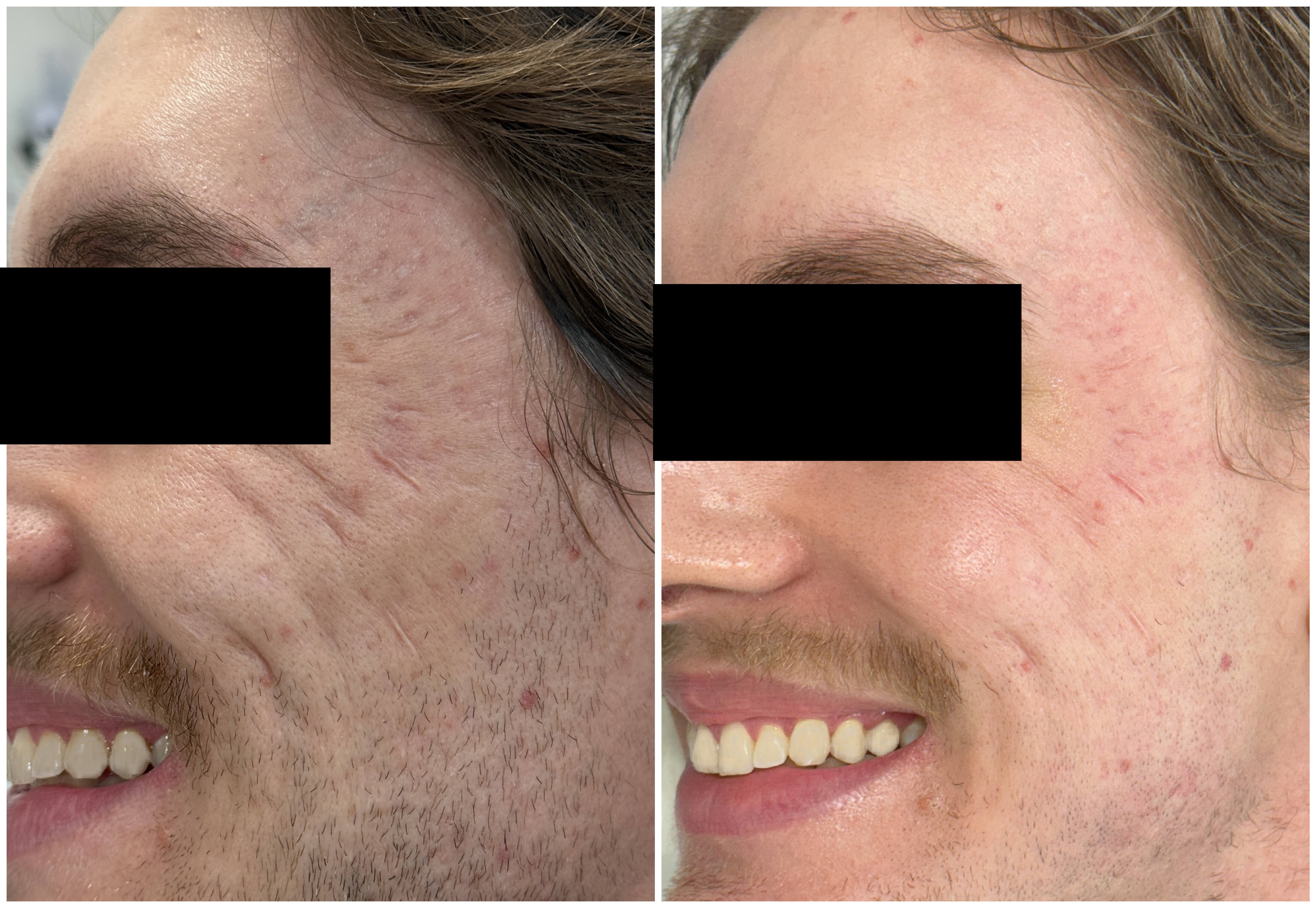 Antes e depois de tratamento estético facial com a Dra. Aline Tanus