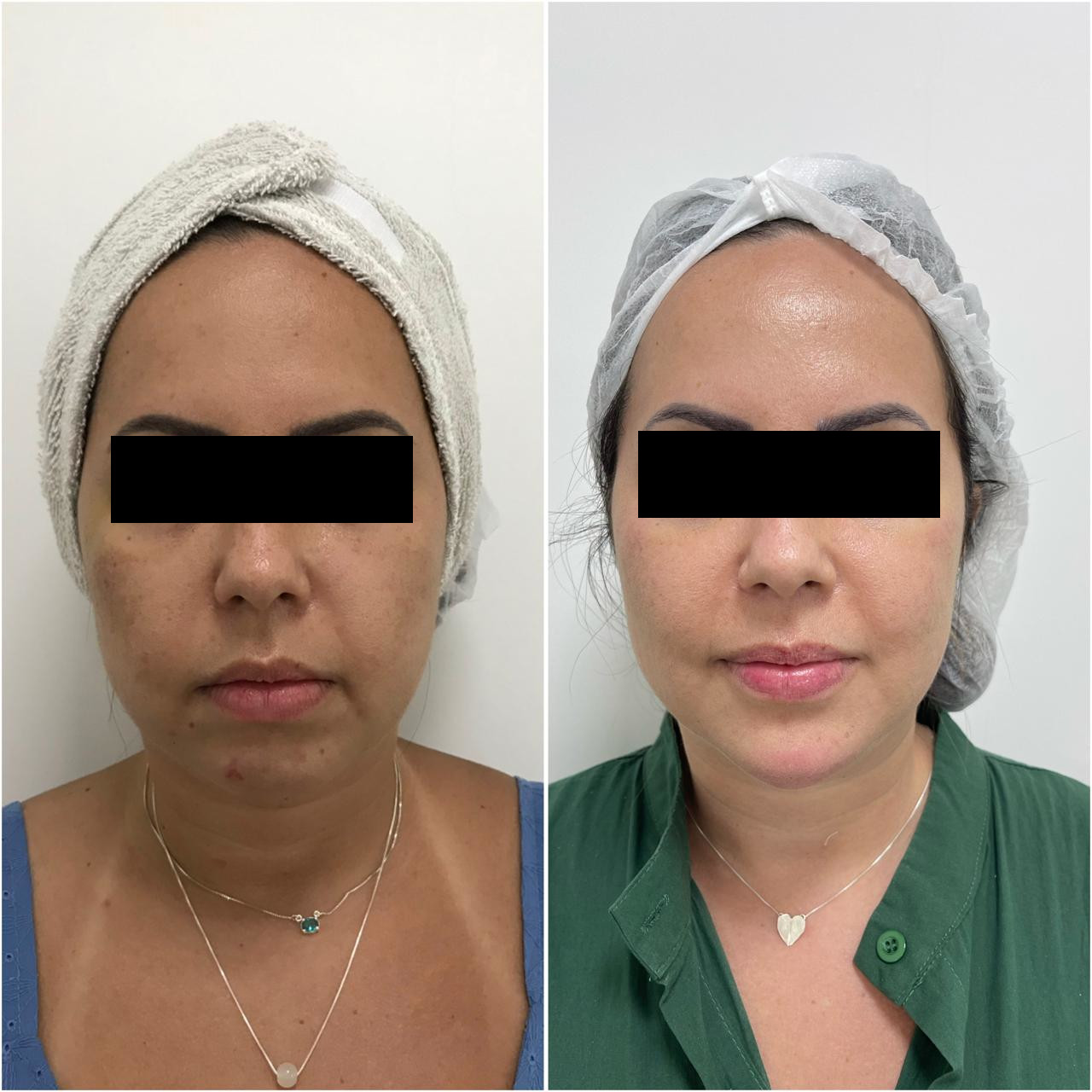 Antes e depois de tratamento estético facial com a Dra. Aline Tanus