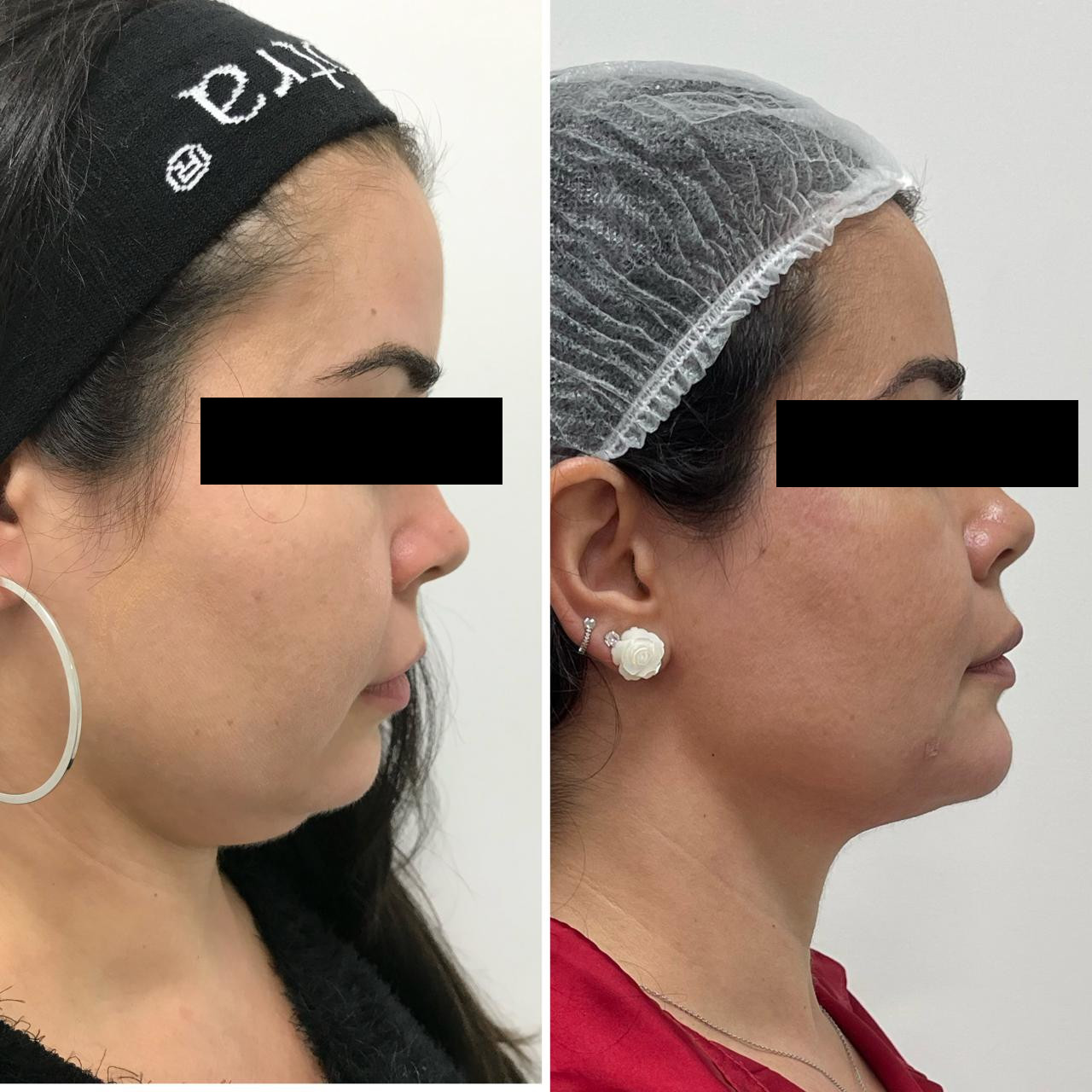 Antes e depois de tratamento estético facial com a Dra. Aline Tanus