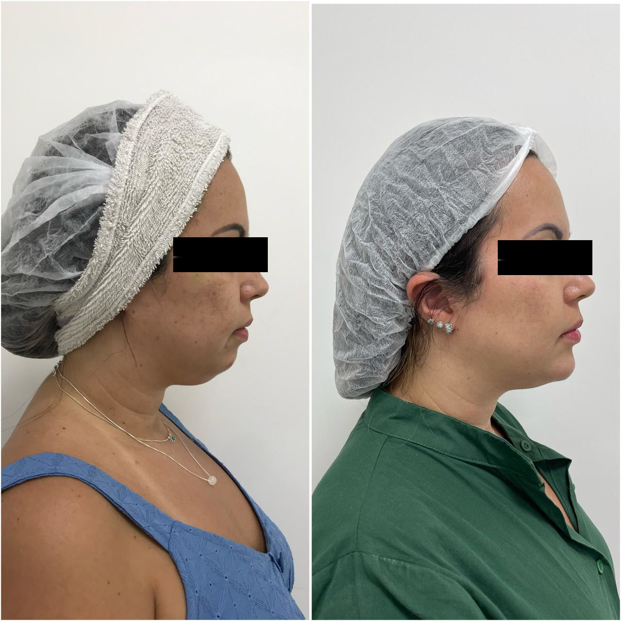 Antes e depois de tratamento estético facial com a Dra. Aline Tanus