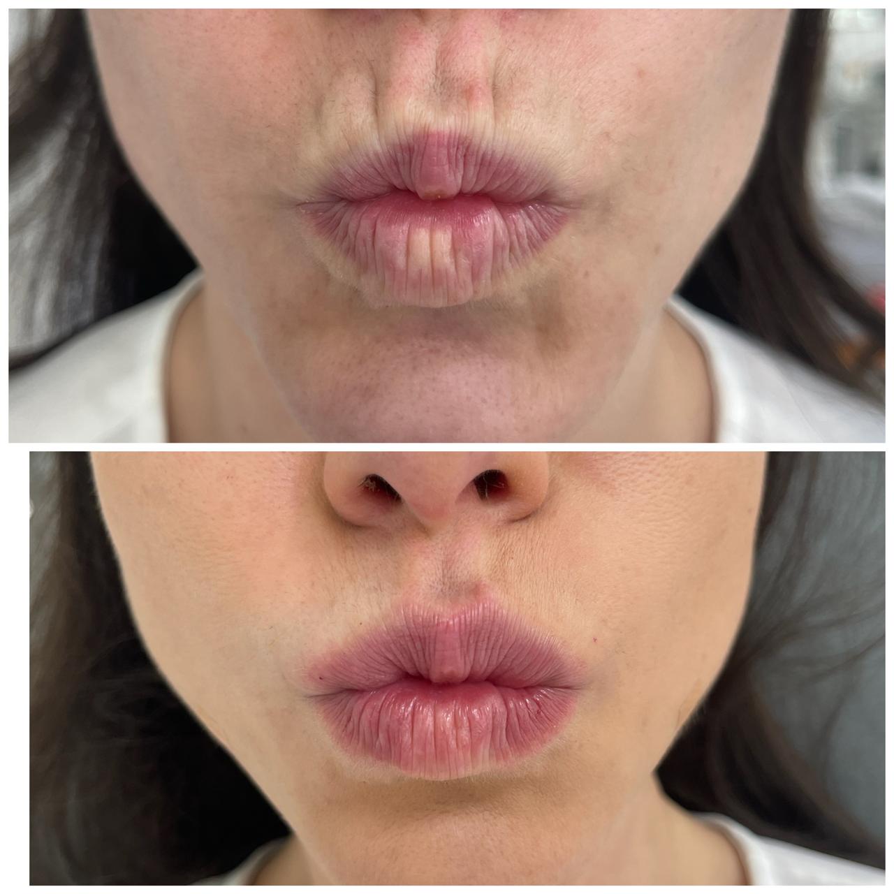 Antes e depois de tratamento estético facial com a Dra. Aline Tanus